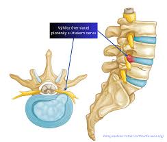 Image result for vyhřezlá ploténka