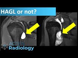Hagl = humeral avulsion glenohumeral ligament the capsule of the shoulder joint, which contains the inferior glenohumeral ligament is ripped off the humerus with dislocation of the shoulder. Shoulder Mri Hagl Or Iatrogenic Extravasation Youtube