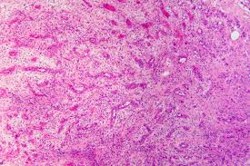 Check spelling or type a new query. Datei Granulation Tissue In An Infected Wound He 2 Jpg Wikibooks Sammlung Freier Lehr Sach Und Fachbucher