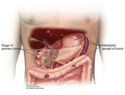 Stage Iv Pancreatic Cancer Pancreatic Cancer Action Network