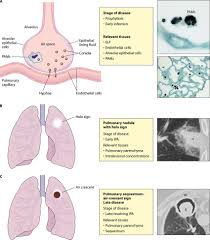 Aspergillosis is an infection, growth, or allergic response caused by the aspergillus fungus. Different Stages Of Invasive Pulmonary Aspergillosis Ipa And The Download Scientific Diagram