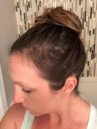 With postpartum alopecia, the hair loss that results is typically gradual and occurs all over the head as more of a thinning effect. How To Quickly Cover Bald Spots During Postpartum Hair Loss Just Simply Mom