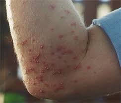 Image result for Fire Ant Sting