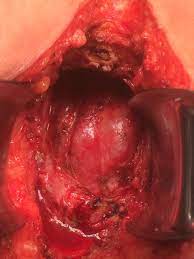 A. Dissect the rectum and sigmoid colon through the perineal wound. B.... |  Download Scientific Diagram