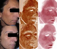 Assessment of the efficacy and tolerance of a new combination of retinoids  and depigmenting agents in the treatment of melasma