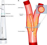Illustration of the distal end of the optical coherence ...