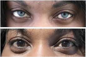 Cirugia De Implante De Iris Artificial Para Cambiar Permanentemente El Color De Ojos Marcianos