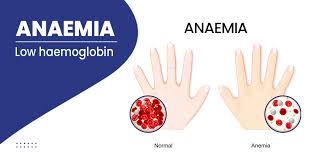 Image result for Anemia