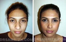 Facial Plastic Surgeon NYC