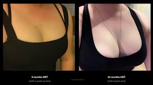 Breast growth timelapse