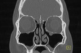 Aspirin® ist bei schmerzen das mittel der wahl. Computertomographie Von Kopf Und Nasennebenhohlen Nnh Ct Ct Mrt Institut Berlin