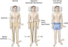Image result for Functional Leg Length Discrepancy