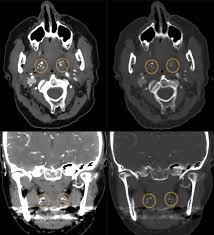 Image result for Tonsillolith