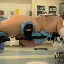 Positioning Overweight Patients For Prone Spine Surgery Is A Well Known Download Scientific Diagram