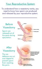 Even though the overall amount of ejaculate a man produces will be reduced by 2% to 5% after a vasectomy, that does not affect the intensity of the orgasm. Vasectomy Clinic Atlanta Vasectomy Expert Doctor Georgia Vasectomy Video
