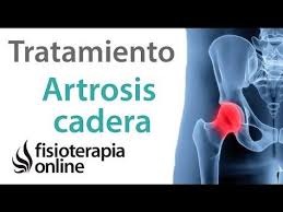 Artrosis De Cadera Tratamiento Con Ejercicios Estiramientos Y Masajes Youtube Estiramientos Dolor De Cadera Ejercicios Lumbares