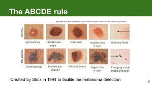 Some types of skin cancer are more dangerous than others, but if you have a spot. Melanoma How To Detect Skin Cancer