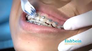 When you do not brush your teeth with braces properly, plaque builds up. How To Brush Your Teeth With Braces On With Pictures Wikihow