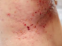 Image result for zoster under breasts