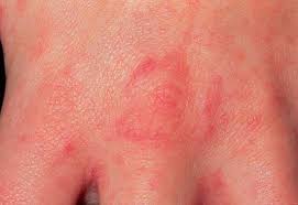 Image result for skin rash similar to scabies