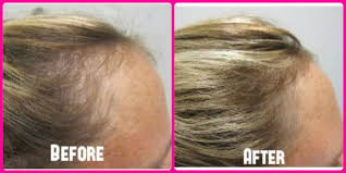 Hair cells grow incredibly fast, but as hair is a nonvital tissue, any deficiency will likely first present itself as excessive shedding, she says. Vitamins Hair Loss List Of Vitamins To Regrow Hair Fast