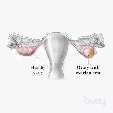How do they affect somebody who is pregnant and somebody who is. Ovarian Cyst Symptoms Risk Factors Types Treatment