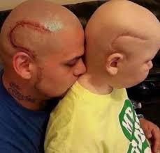 Have you ever tattooed your scars?