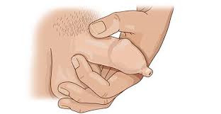 Image result for Phimosis