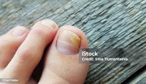 Image result for Onycholysis feet