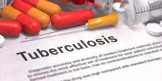 Image result for Tuberculosis Screening