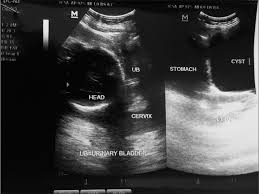 Image result for corpus luteum sonography)