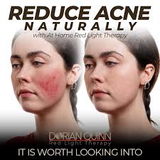 Ready to stop treating the symptoms of acne and begin treating acne at the  source?