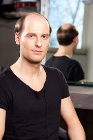 Die häufigste form ist der erblich bedingte haarausfall bei männern. Haarausfall Und Haarersatz Fur Manner My Hair And Me De