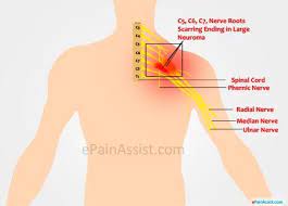 Brachial Plexus Brachial Pinched Nerve Treatment Pinched Nerve