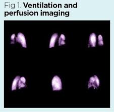 Image result for Ventilation Perfusion Scan