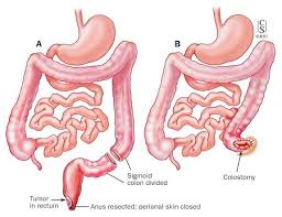 Stage I Colorectal Surgery