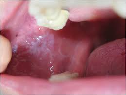 Image result for lichen planus on tongue)
