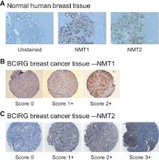 Get information on breast cancer (breast carcinoma) awareness, signs, symptoms, stages, types, treatment, and survival rates. N Myristoyltransferase Proteins In Breast Cancer Prognostic Relevance And Validation As A New Drug Target Springerlink