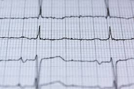 Die ursachen einer herzmuskelentzündung (myokarditis) sind vielfältig. Belastungs Ekg Abauf Kosten Das Wichtigste Auf Einen Blick