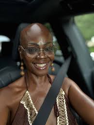 Good Morning, my name is Sandey Greene, I reside in Birmingham, Alabama.  I'm living with a diagnosis called Areata Alopecia, that has called me to  Bald. I was embarrassed and wore wigs,