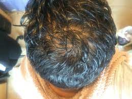 Fine hair just means the strand itself is thin, but there can still be a lot of soft, light shades tend to complement both warm and cool skin tones. Hair Looks Thin When Wet But No Miniaturisation Still Balding Or What Hairlosstalk Forums