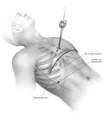 Image result for Pectus Excavatum