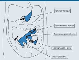 Es gibt verschiedene arten von bauchwandbrüchen. Seltene Ursachen Der Intestinalen Obstruktion Springerlink
