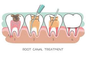 There are times when some patients may be enticed to have a root canal procedure done prior to crown preparation. Guidelines That You Need To Follow For Root Canal Treatment Yorkhill Endodontics