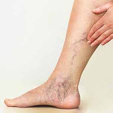 Image result for Stasis Dermatitis