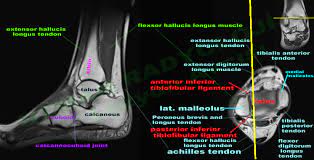 The muscles with proximal attachments at points outside the foot are referred to as extrinsic. Mri Ankle Google Search Medical Anatomy Foot Anatomy Mri