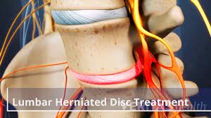 Spinal fusion uses bone grafts and surgical hardware to join 2 or more individual vertebrae into one solid piece of bone and metal. Lumbar Herniated Disc Treatment Video