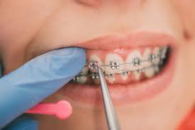Find out how and when you you should be able to eat with your braces rubber bands on without any issue. What Do The Rubber Bands On Braces Do South Surrey Smiles