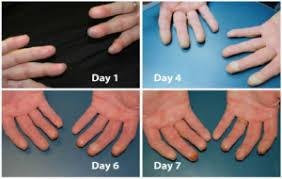 All other frostbite requires medical attention because it can damage skin, tissues, muscle and bones. Frostbite Wikem