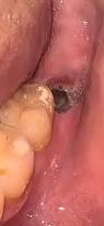Image result for Alveolitis sicca)